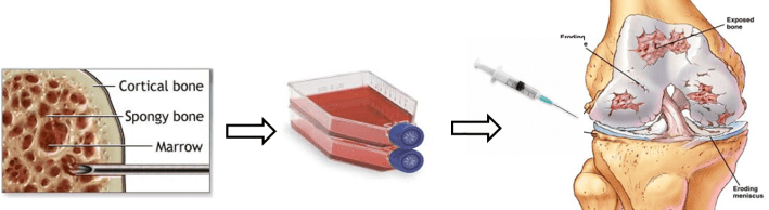 Figure 5: The concept behind stem cells therapy. Bone marrow is a source of adult stem cells. To obtain the cells, bone marrow is often harvested from the iliac crest (pelvis). The harvested mix of cells undergoes specialised culture techniques to remove contaminating cells to produce a more purified population of cells. These cells are cultured in vitro (which means “in glass” but on plastic is a more accurate description!). After several weeks of culturing, sufficient numbers of stem cells are produced which can the injected back into the patient to produce a therapeutic effect. At REMEDI we are using adipose (fat) derived stem cells which we inject into the knee joint space of patients suffering with Osteoarthritis.